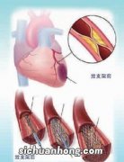 针对心脏支架手术的几个疑问