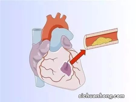 血栓抽吸能代替支架医治吗?