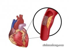 什么情况下，需做心脏支架？