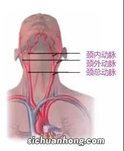 高危路段 颈动脉