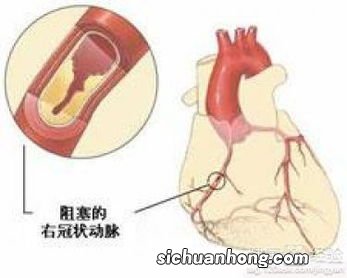 这些行为有助于支架术后减缓心脏不适