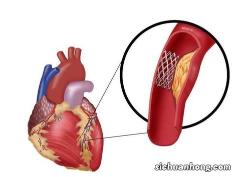 装上“心脏支架”后，到底还能活多久呢？医生说出实情，或可参考