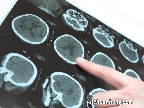 普通CT vs 增强CT