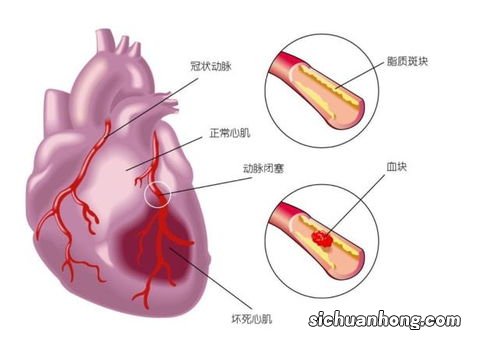 安装心脏支架后，还能活多少年？医生说出大实话，请转告家人