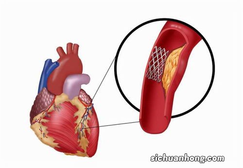 心脏支架手术的缺点