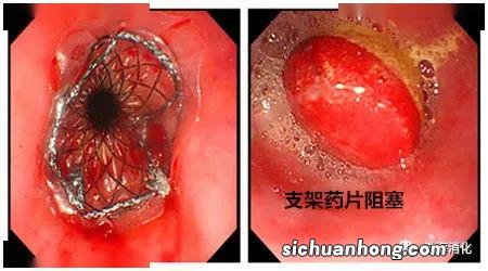 支架内再狭窄原因有什么呢？