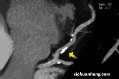 警惕冠脉造影“副作用”，3种人别轻易尝试