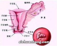 HPV 人乳头瘤病毒——宫颈癌