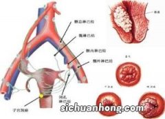 宫颈癌前病变与宫颈癌的关系