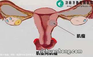 体检查出子宫肌瘤如何办？