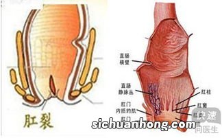 肛裂的症状有哪些？