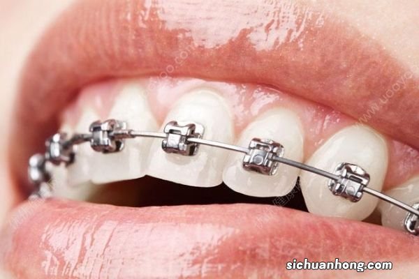 暑假儿童扎堆整牙,医生:吃得太精细太甜易致龅牙