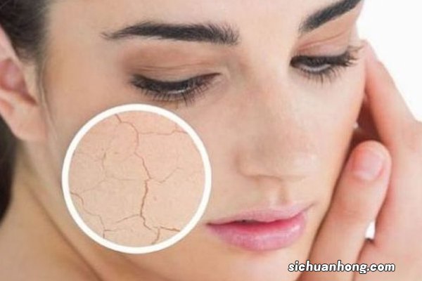 冬天皮肤三大问题你有吗?看医生怎样支招