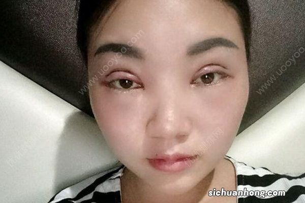 女子花5300元割双眼皮，3年后想退款：左眼是四眼皮