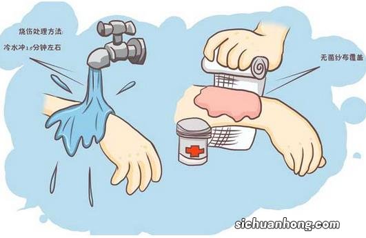 如何处理烧烫伤后起的水泡?