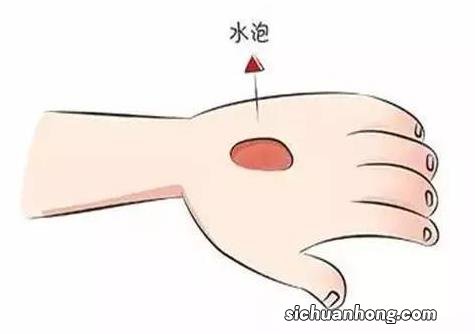 烫伤的水泡能挑破吗 科学处置烧烫伤方法