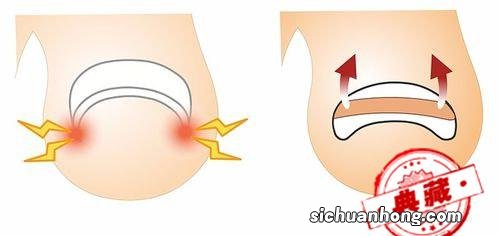 嵌甲最佳治疗方法——嵌甲矫正CC正甲贴怎么用