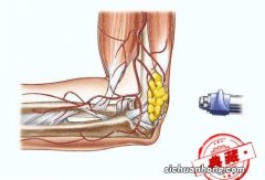 网球肘最佳治疗方法