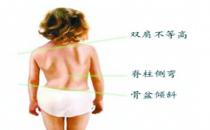 如何尽早发现孩子脊柱侧弯?