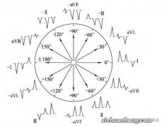 心电轴右偏是什么意思