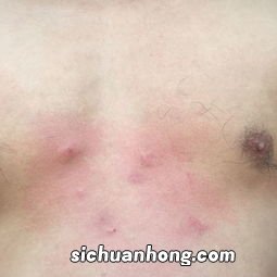 皮肤里面有硬疙瘩怎么办 了解皮肤里面有硬疙瘩怎么办