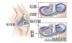 半月板在哪个部位