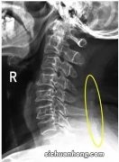 项韧带钙化是什么意思