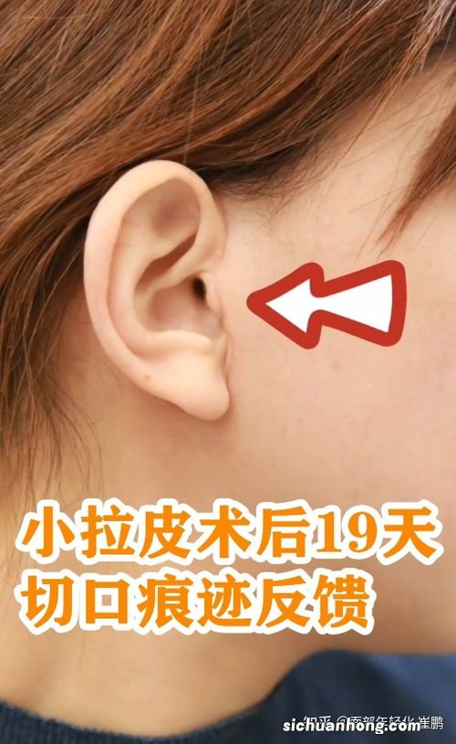小拉皮可以保持多久