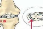 半月板损伤的临床症状与表现 半月板二级损伤严重吗