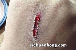 女人梦到伤口裂开什么意思