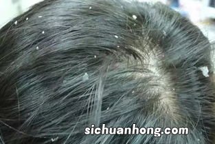 梦见头皮屑