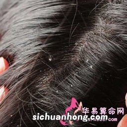梦见头皮屑