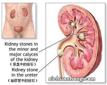 肾结石要少吃什么食物