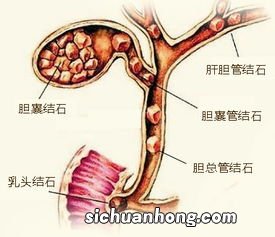 胆囊炎吃什么会好的快