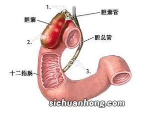 胆囊炎吃什么会好的快