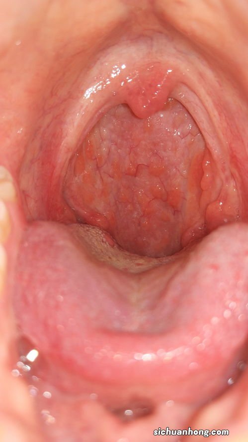 咽炎喝什么比较好