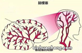脑梗 不能吃什么