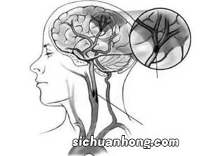 脑梗 不能吃什么