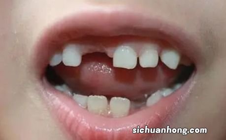 梦见掉牙