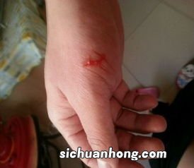 梦见蛇咬我手流血了