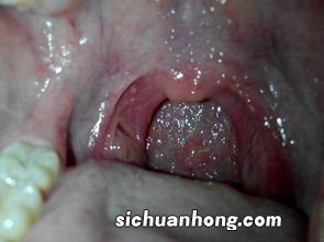 小孩喉咙痛吃什么菜