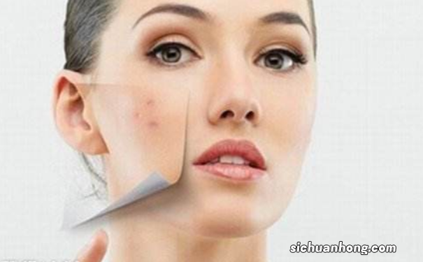 脸上痘印变黑如何淡化?痘印变黑怎样淡化?