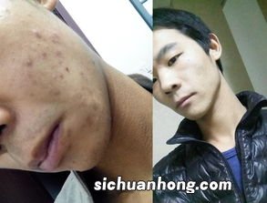 爱起痘喝什么