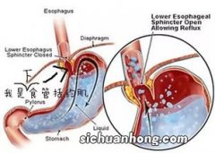 术前吃什么能清空肠胃