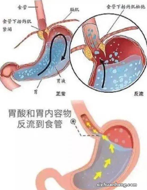 术前吃什么能清空肠胃