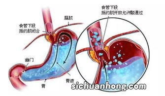 术前吃什么能清空肠胃