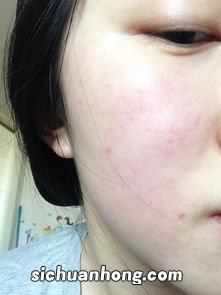 脸过敏吃点什么东西好