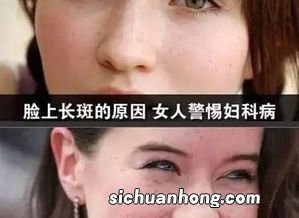 去了斑要多久掉痴