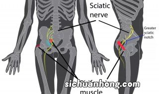 梨状肌可以自愈吗 梨状肌能自愈吗