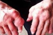 痛风人吃什么菜好 痛风患者一定要买这八种蔬菜